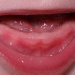 Типичные симптомы прорезывания зубов